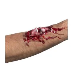 Gebroken Been Litteken